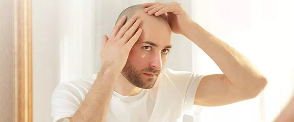 Виды облысения 2